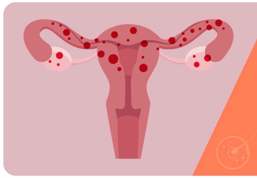 Endometriose, entenda o que é, e os tipos de tratamento para cada mulher